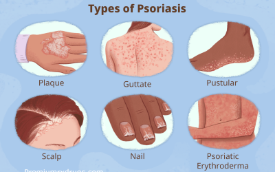 Psoriasis- Symptoms, Types, Causes, Diagnosis and Treatment Options