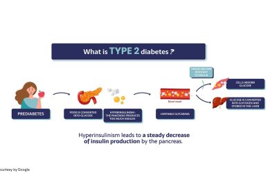 An Overview of Type 2 Diabetes