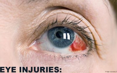 Eye Injuries Affecting your Daily Life