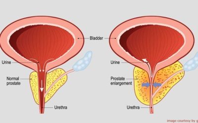 Enlargement of Prostate: A Benign and Harmless Problem