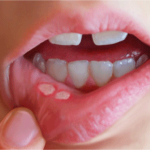 What Causes Canker Sores and Treatment