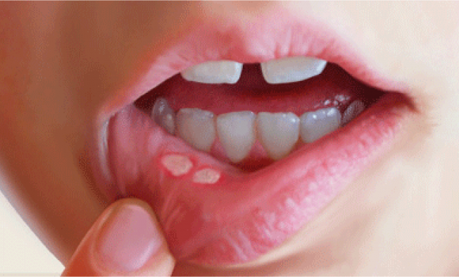 What Causes Canker Sores and Treatment