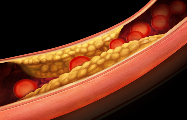 Anti-platelet drugs- Clopidogrel