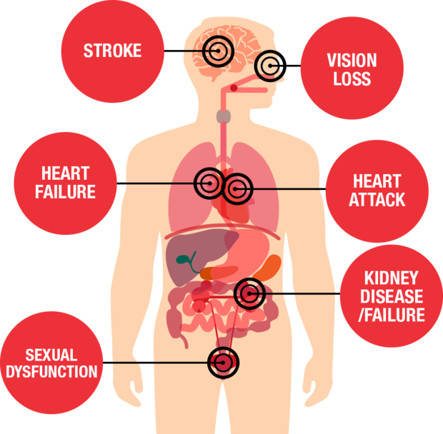 High blood pressure overview