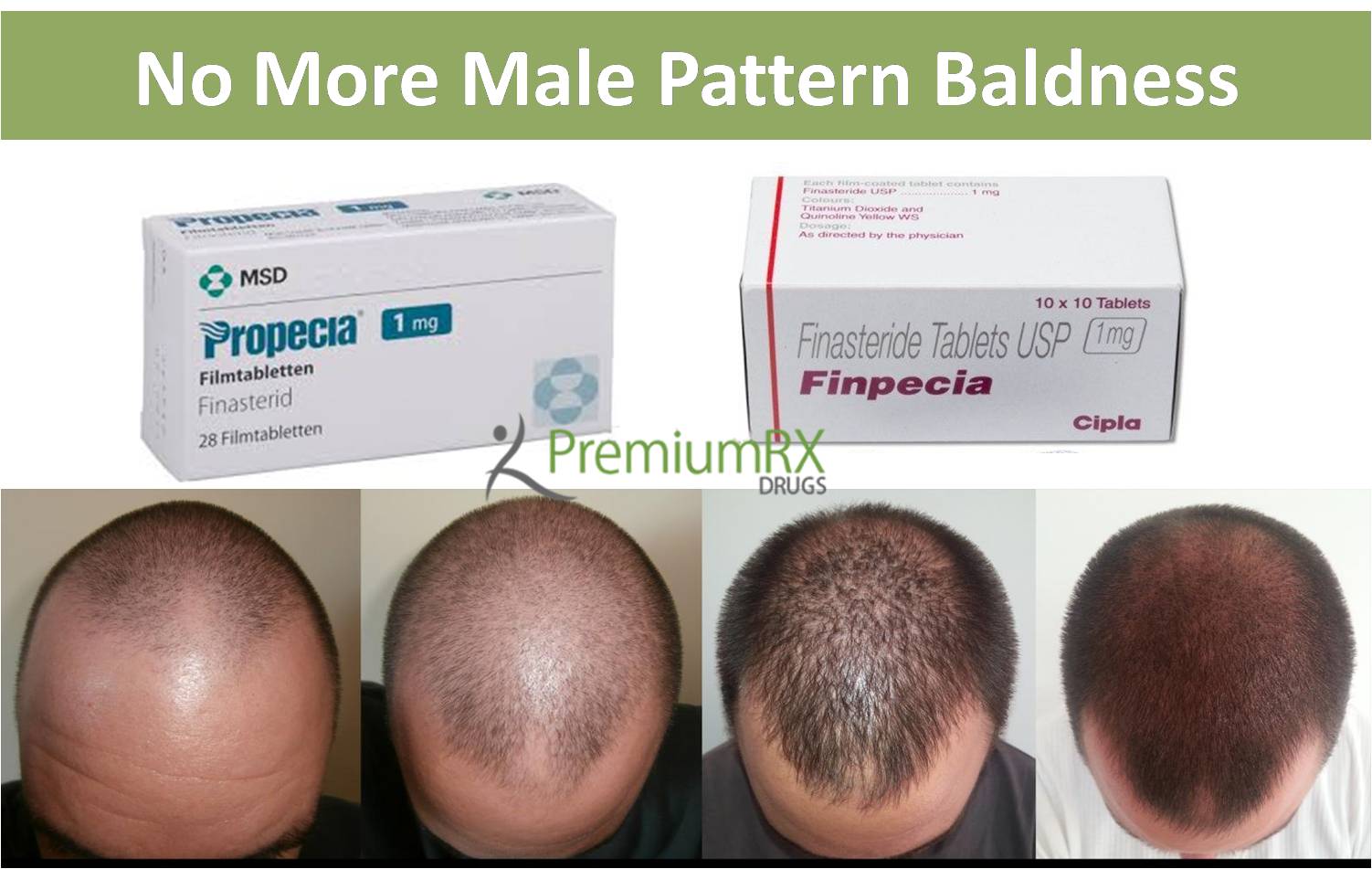 Generic Finasteride vs Propecia