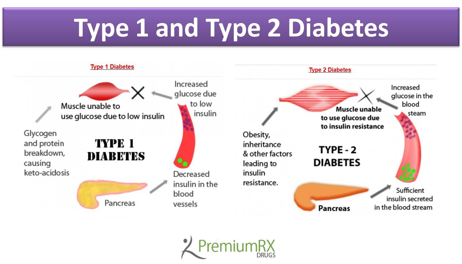 Difference between Type 1 and Type 2 Diabetes