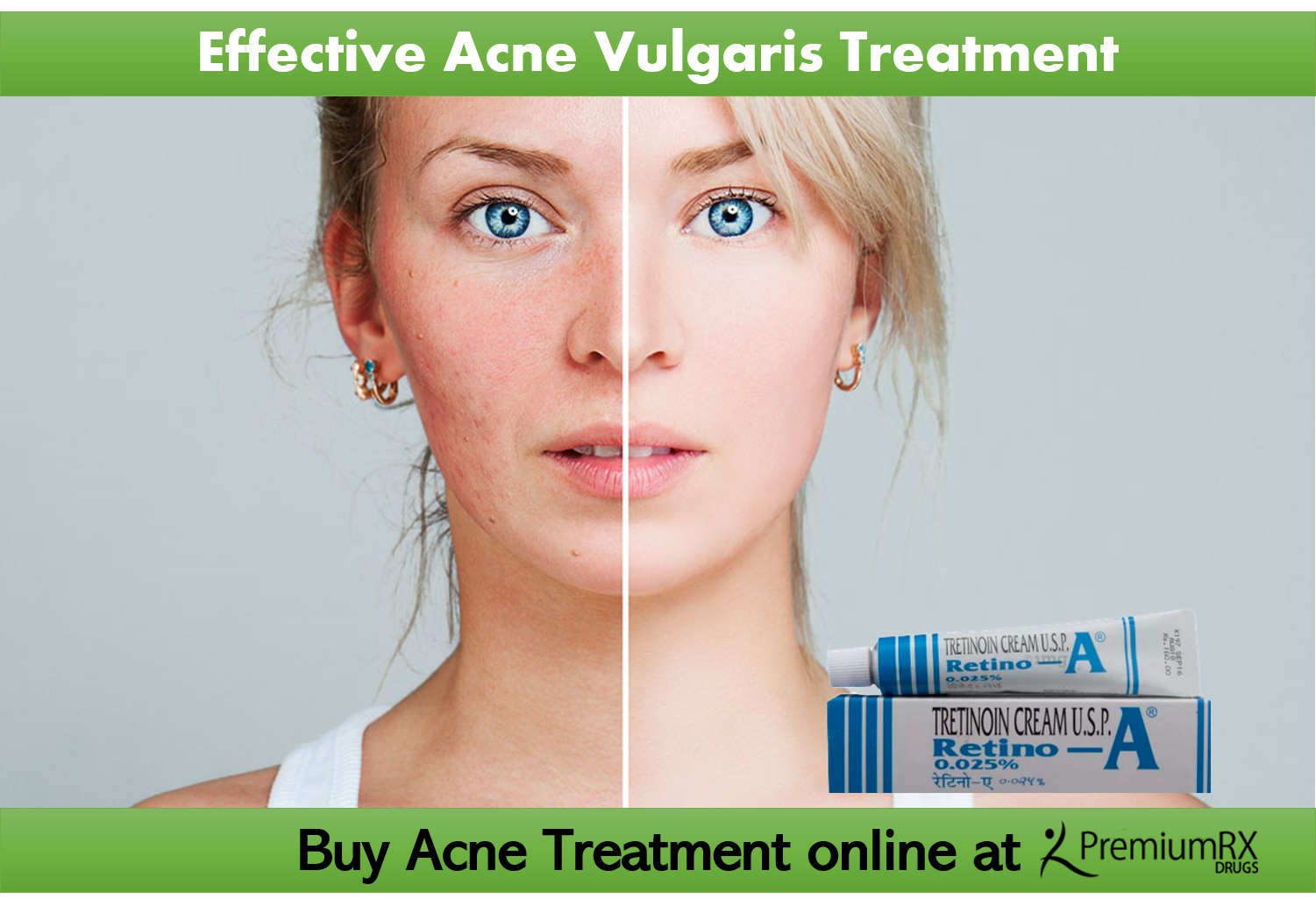 Understanding Acne Vulgaris