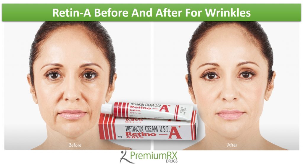 RetinA Before And After For Wrinkles PremiumRx Online Pharmacy