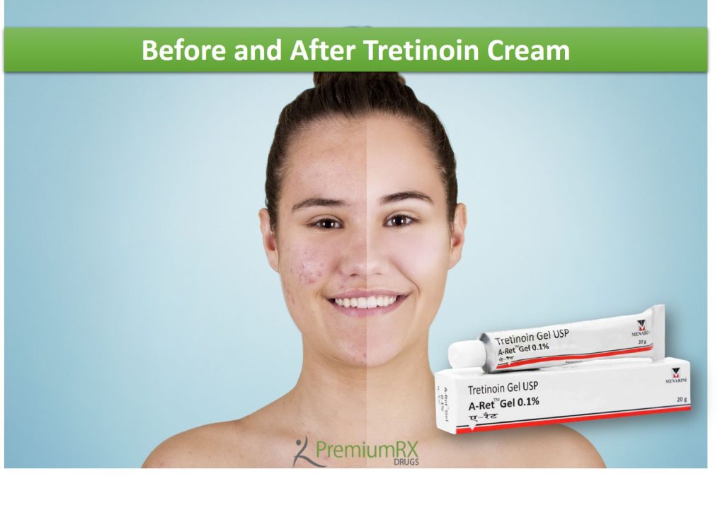 Before and After Tretinoin Cream PremiumRx Online Pharmacy