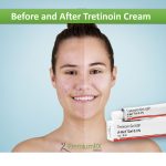 Before and After Tretinoin Cream