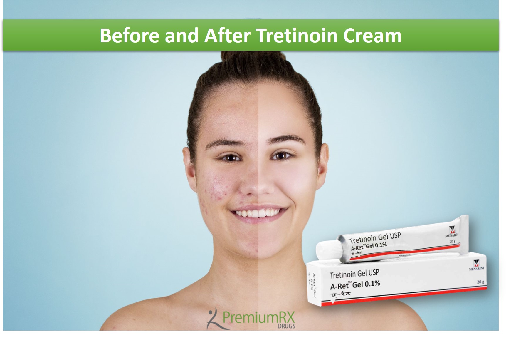 Before and After Tretinoin Cream