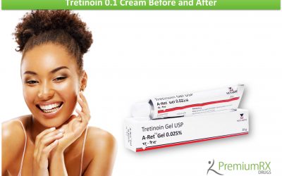Tretinoin 0.1 Cream Before and After