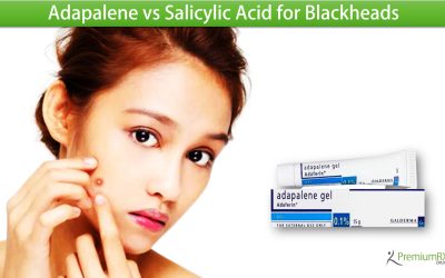 Adapalene vs Salicylic Acid for Blackheads