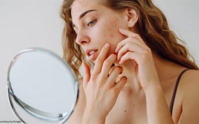 A Ret Gel .1% Results: Real Before & After Examples